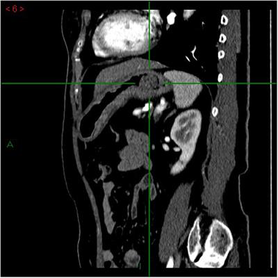 Case Report: Two Is Not (Always) Better Than One: Pyloric Gland Adenoma of the Gastric Cardia and Concurrent Neuroendocrine Cell Dysplasia Arising From Autoimmune Gastritis